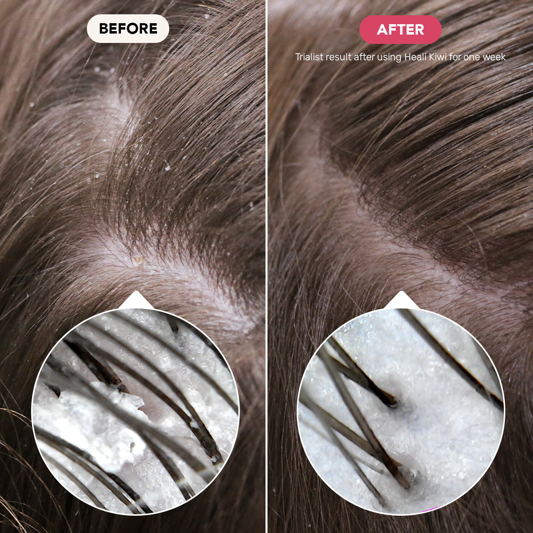 Heali Kiwi before and after. trialist result after using heali kiwi for one week.